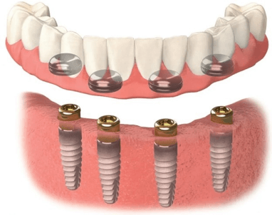 Dental Implant Image